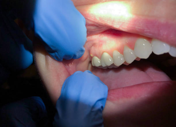 Best Emergency Tooth Extraction in Ayden, NC
